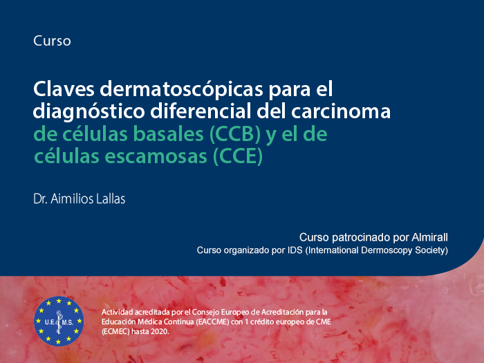 Claves dermatoscópicas para el diagnóstico diferencial del carcinoma de células basales (CCB) y el de células escamosas (CCE)