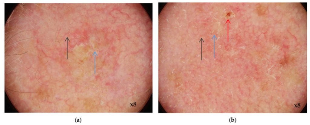 Fig 1 Dermatoscopia de la queratosis actinica