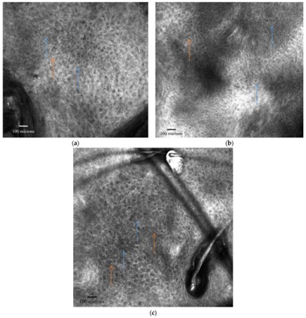 Fig 2 Microscopia confocal de reflectancia de la queratosis actinica