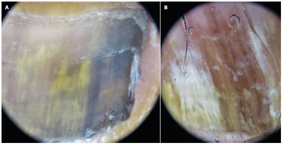 Figura 6 Melanoniquia fungica