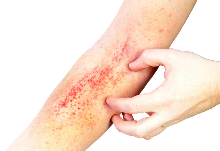 Diagnóstico diferencial dermatitis atópica y psoriasis 1 Diagnostico diferencial DA y PSO