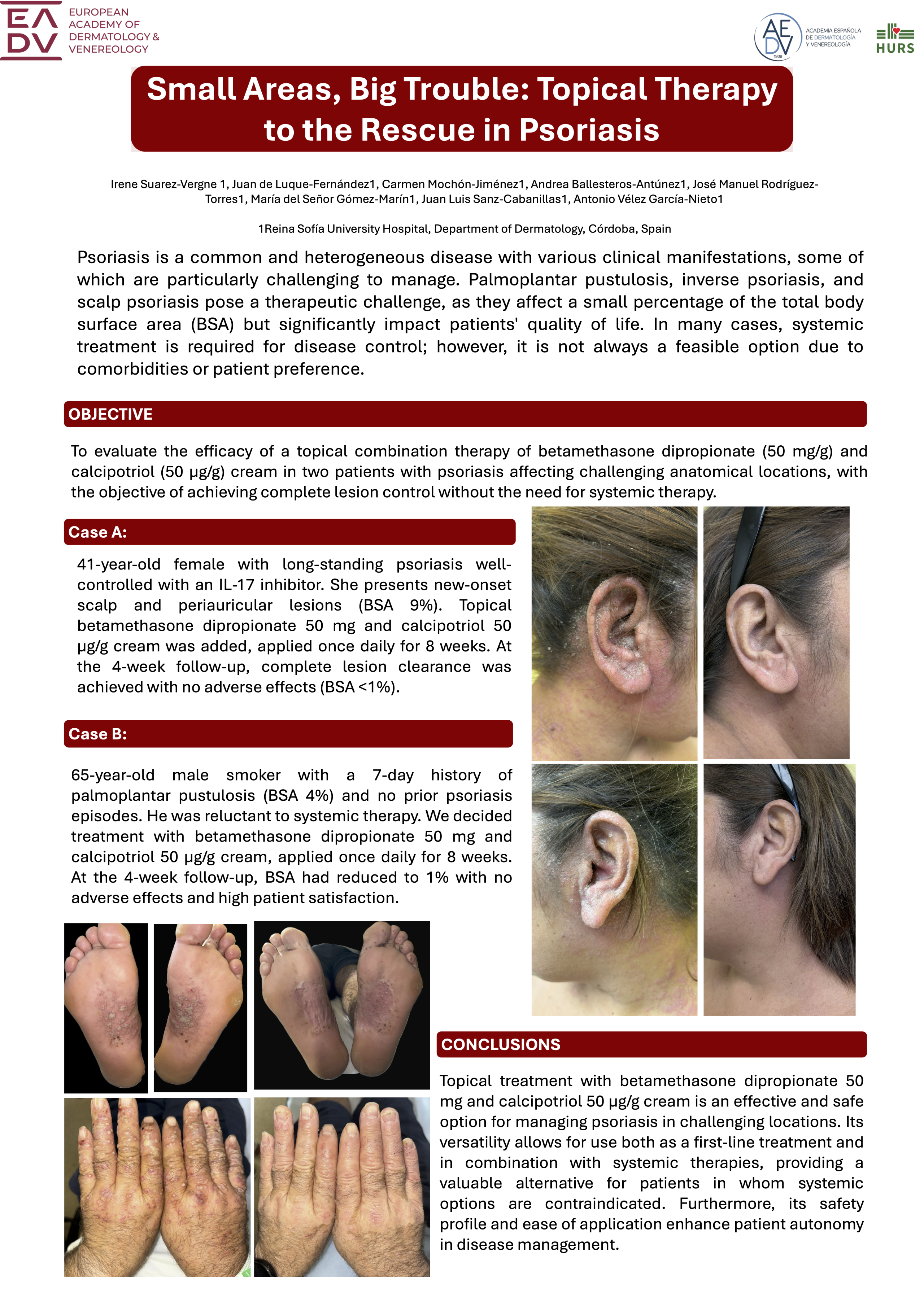 Small Areas, Big Trouble: Topical Therapy to the Rescue in Psoriasis