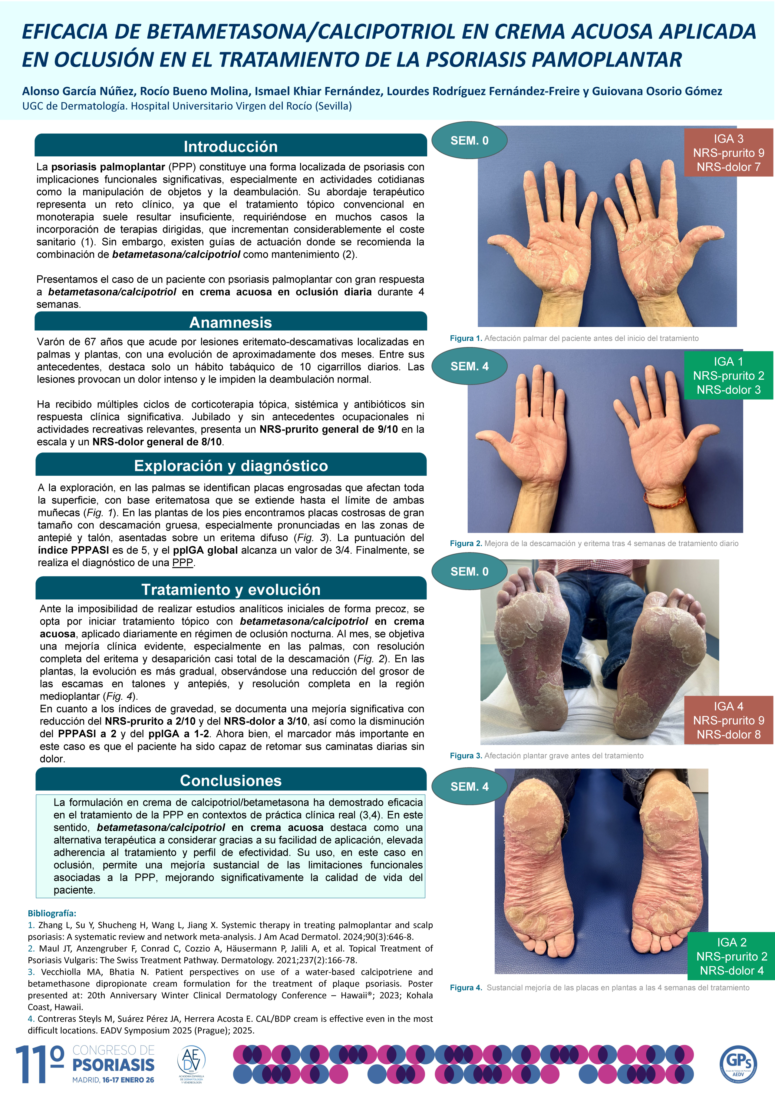 Eficacia de betametasona/calcipotriol en crema acuosa aplicada en el tratamiento de la psoriasis pamoplantar