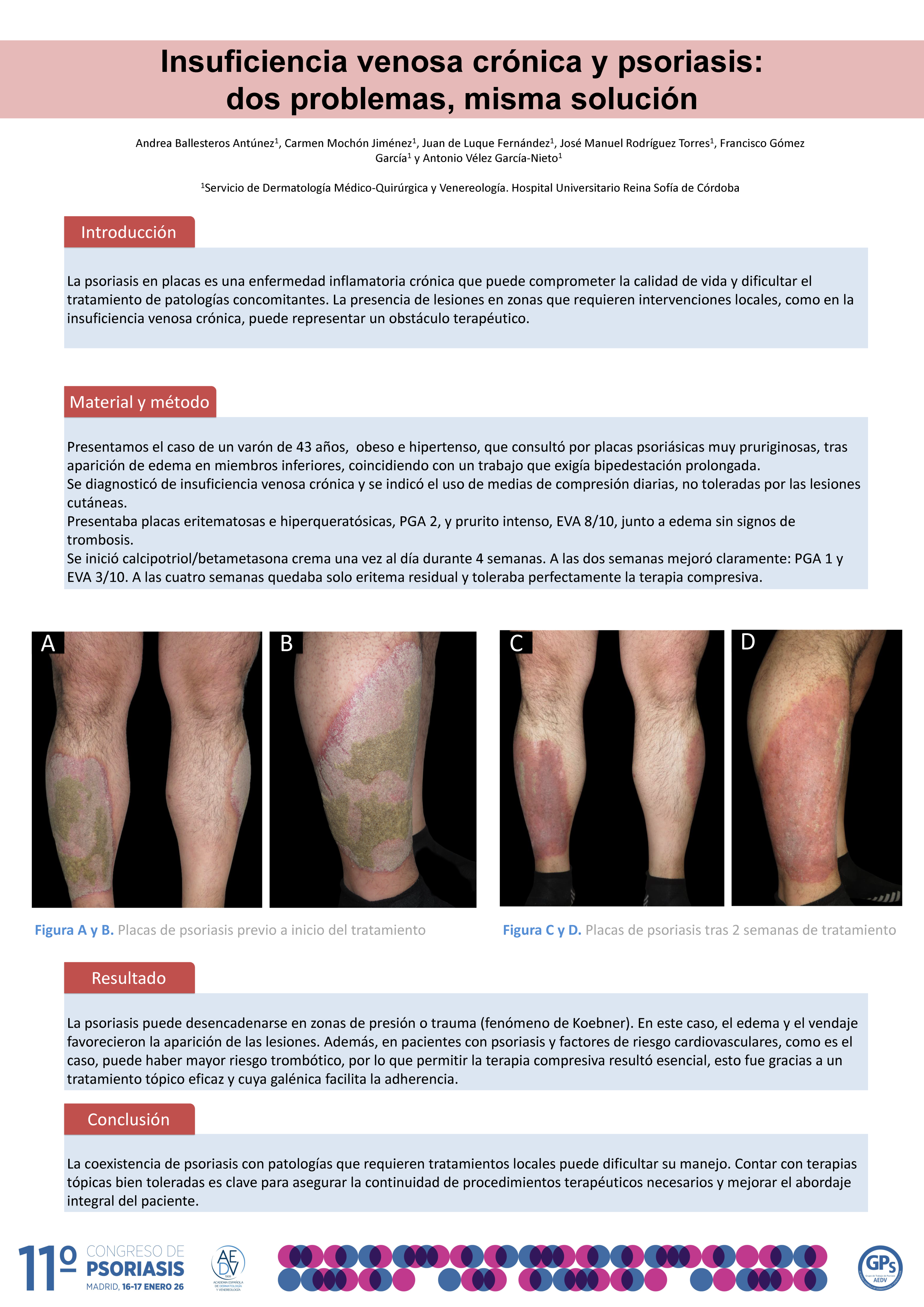 Insuficiencia venosa crónica y psoriasis: dos problemas, misma solución