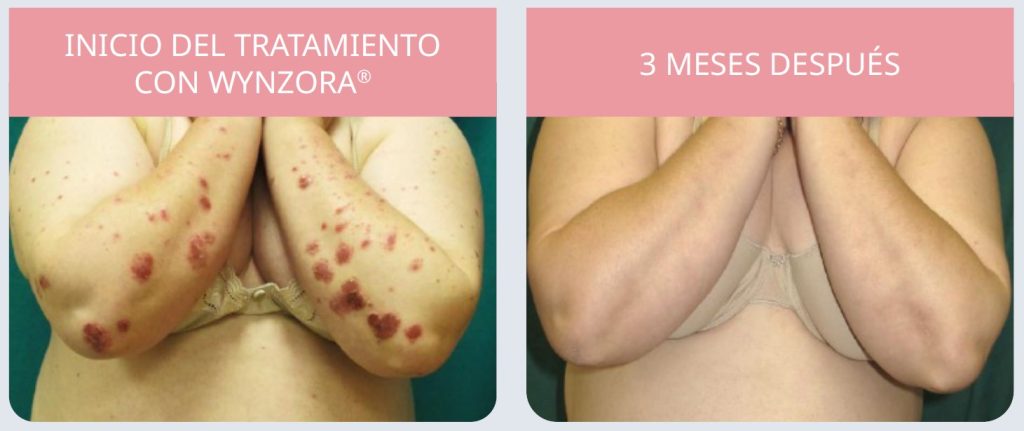 El efecto dominó de la psoriasis 8 Fig 8 Evolucion Wynzora paciente oncologica con obesidad
