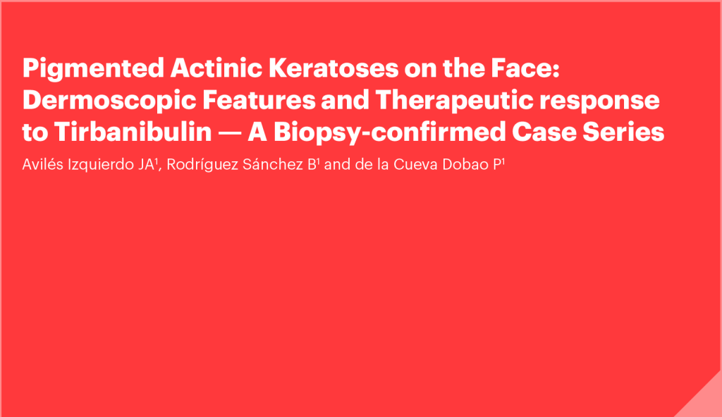 Pigmented Actinic Keratoses on the Face: Dermoscopic Features and Therapeutic response to Tirbanibulin - A Biopsy-confirmed Case Series