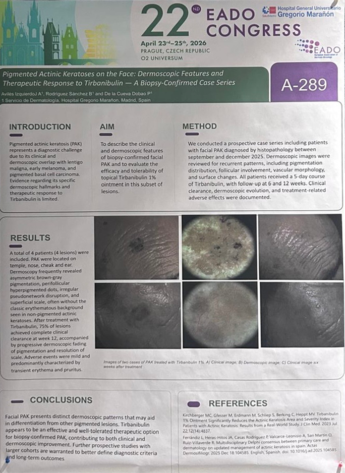 Pigmented Actinic Keratoses on the Face: Dermoscopic Features and Therapeutic response to Tirbanibulin - A Biopsy-confirmed Case Series